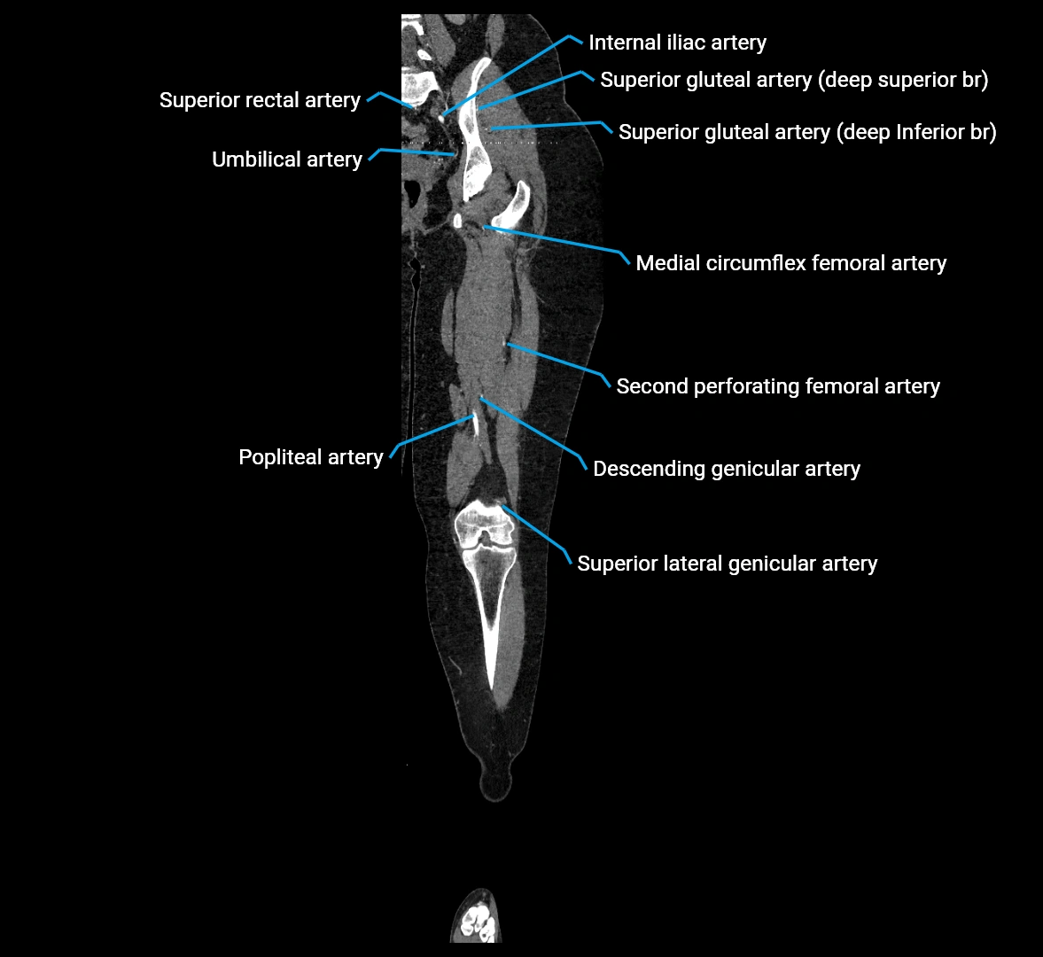 CTA lower limb coronal cross sectional anatomy labelled image _47 (2).webp